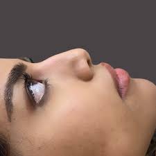 5 benefits of non surgical rhinoplasty