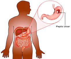 treatment for peptic ulcer treatment