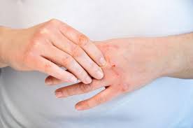 atopic dermais eczema causes