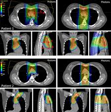 pencil beam scanning proton therapy of