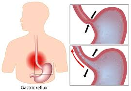 gastro esophageal reflux disease