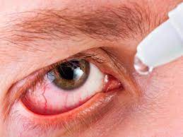 what is dry eye causes symptoms