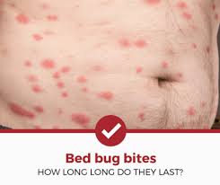 how long do bed bug bites last a