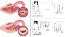 Image result for icd 10 code for mild mitral annular calcification