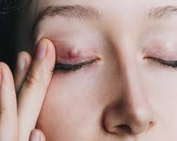 chalazion all your questions answered