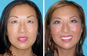 Asian Eyelid Surgery Reviews, Cost, Before & After | Plastic Surgery Review