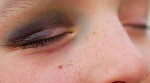 the bruise under the eye how to heal