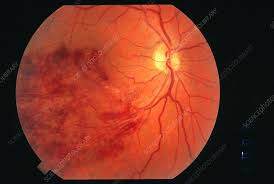retinal blood vessel disease stock