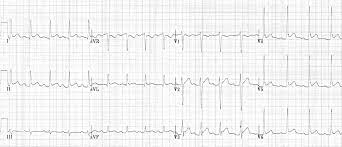 Premature atrial/ventricular beats concave upward st segment elevation in all leads st depression in avr or v1 t waves flattenas st elevation returns to base line no reciprocal. Pericarditis Ecg Changes Litfl Ecg Library Diagnosis