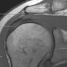Acromion is an anterolateral oblong projection of the spine of scapula (shoulder blade) that runs laterally then anteriorly above the supraspinous fossa and is the summit of the shoulder on palpation. Acromion An Overview Sciencedirect Topics