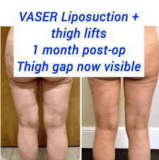 thigh lift thighplasty harley clinic