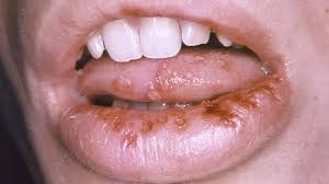 Oral herpes involves the face or mouth. Herpes Symptoms Causes And Treatment