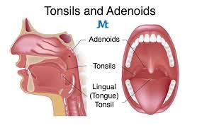 tonsillectomy and adenoidectomy