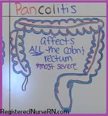 Ulcerative Colitis Nclex Review