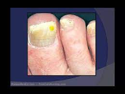 toenail debridement by a podiatrist