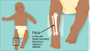 Fibular Hemimelia For Parents Nemours Kidshealth