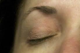 dry skin patches on my eyelids ask dr