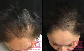 women s hair loss and alopecia female