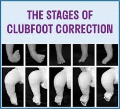 Treatment for club foot usually starts within 1 to 2 weeks of your baby being born. Treatment Strategies Paley Orthopedic Spine Institute