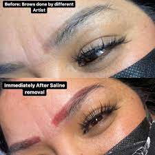 saline tattoo removal one of the best