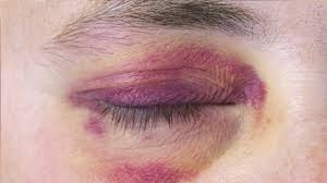 13 home remes for black eye causes
