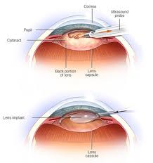 eye cataract surgery top eye doctors
