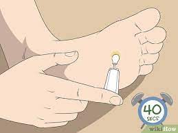 how to freeze plantar warts wikihow