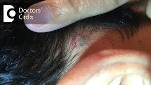 painful lump behind the ear