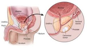 symptoms of prostate cancer once a tumor causes your prostate gland to swell, or once cancer spreads beyond your prostate, you may have symptoms including: What Is Prostate Cancer