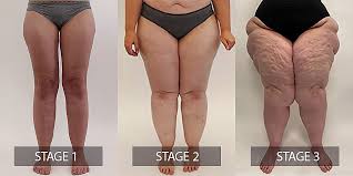 lipedema and body fat photos