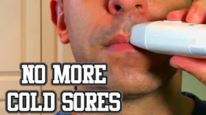 electronic cold sore device