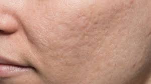 bellafill acne scar bellafill for