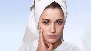 tips to hide pimples without makeup