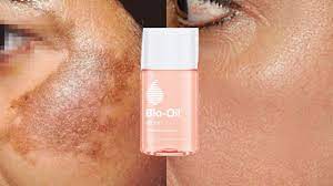 Will bio oil work for it. Pin On Bio Oil Before And After