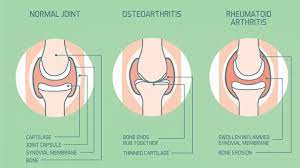 rheumatoid arthritis joint pain vs