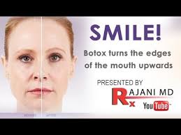 smile botox injected to turn the mouth