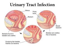 Ayurvedic Treatment Of Urinary Tract Infections Uti