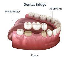 dental bridges in brooklyn ny tooth