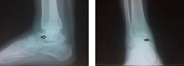    best X Ray images on Pinterest   Radiology humor  Medical humor     Medscape Reference