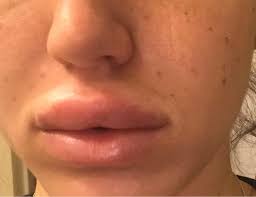 lips super swollen after restylane i
