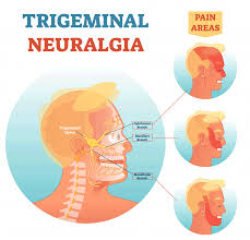 home remes for trigeminal neuralgia