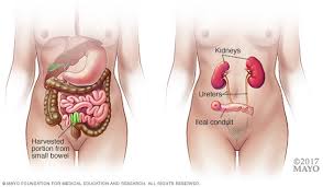 The signs and symptoms of bladder cancer can vary based on the size and location of the tumor as well as the stage of the disease. Bladder Cancer Diagnosis And Treatment Mayo Clinic
