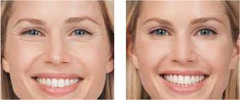 How long does it take for botox to work on forehead. How Long Does Botox Take To Work Promd Health Botox