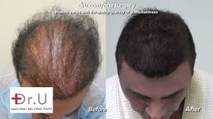 But this depends on the experience and skill set of the fue hair. Video Hair Restoration And Transplant Repair By Dr U