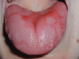 Geographic Tongue Causes Pictures And Treatment