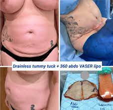simple aftercare 5 tummy tuck recovery