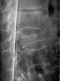 Image result for Thoracic spine compression fracture