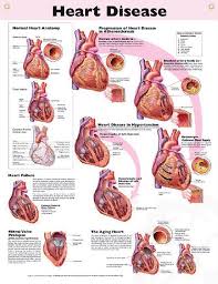 Heart Disease Anatomy Poster Congestive Heart Failure