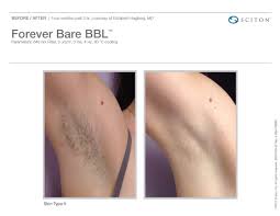 laser hair removal st louis mo