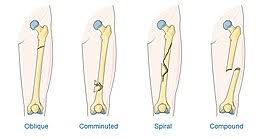 However, details about this type of injury can be found only rarely in the literature. Maisonneuve Fracture Wikipedia